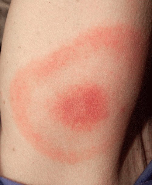 photo of rash. text description follows