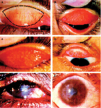 Figure. World Health Organization simplified trachoma grading classification system